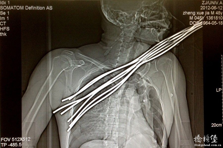 钢绞线穿胸而过CT片